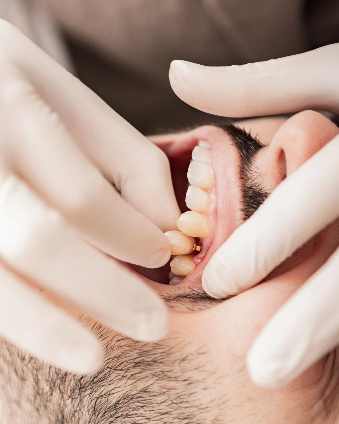 Dental bridge procedure in Chennai