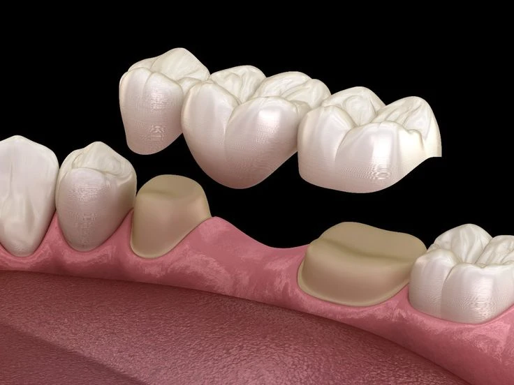 Dental bridges treatment in Chennai