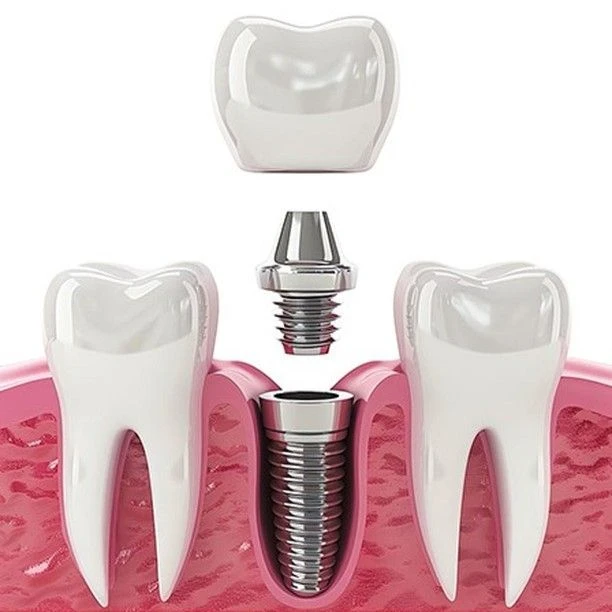 Dental implants treatment in Chennai