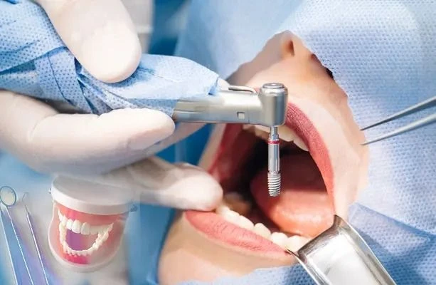 Dental implant procedure in Chennai
