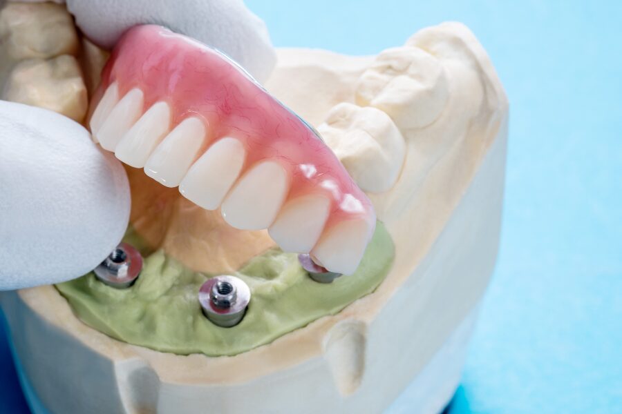 Denture procedure Chennai