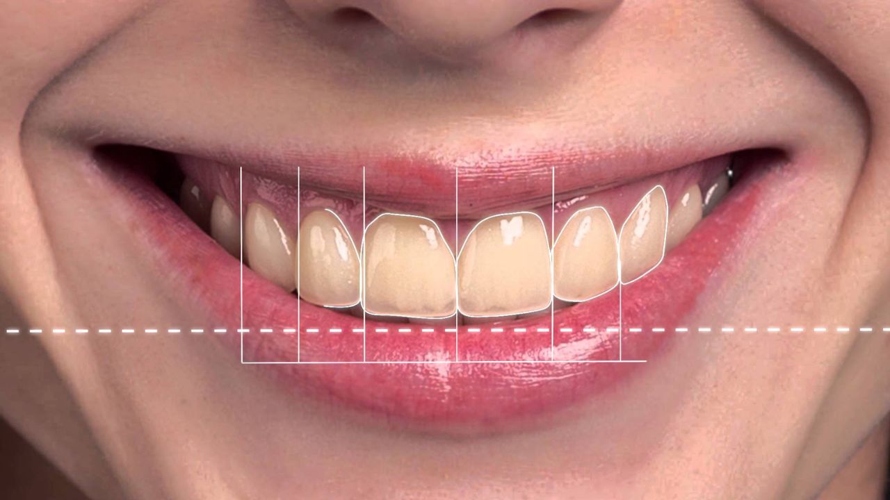 Digital smile designing in Chennai
