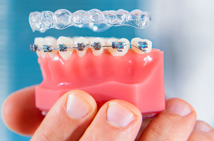 Clear aligners procedure Chennai