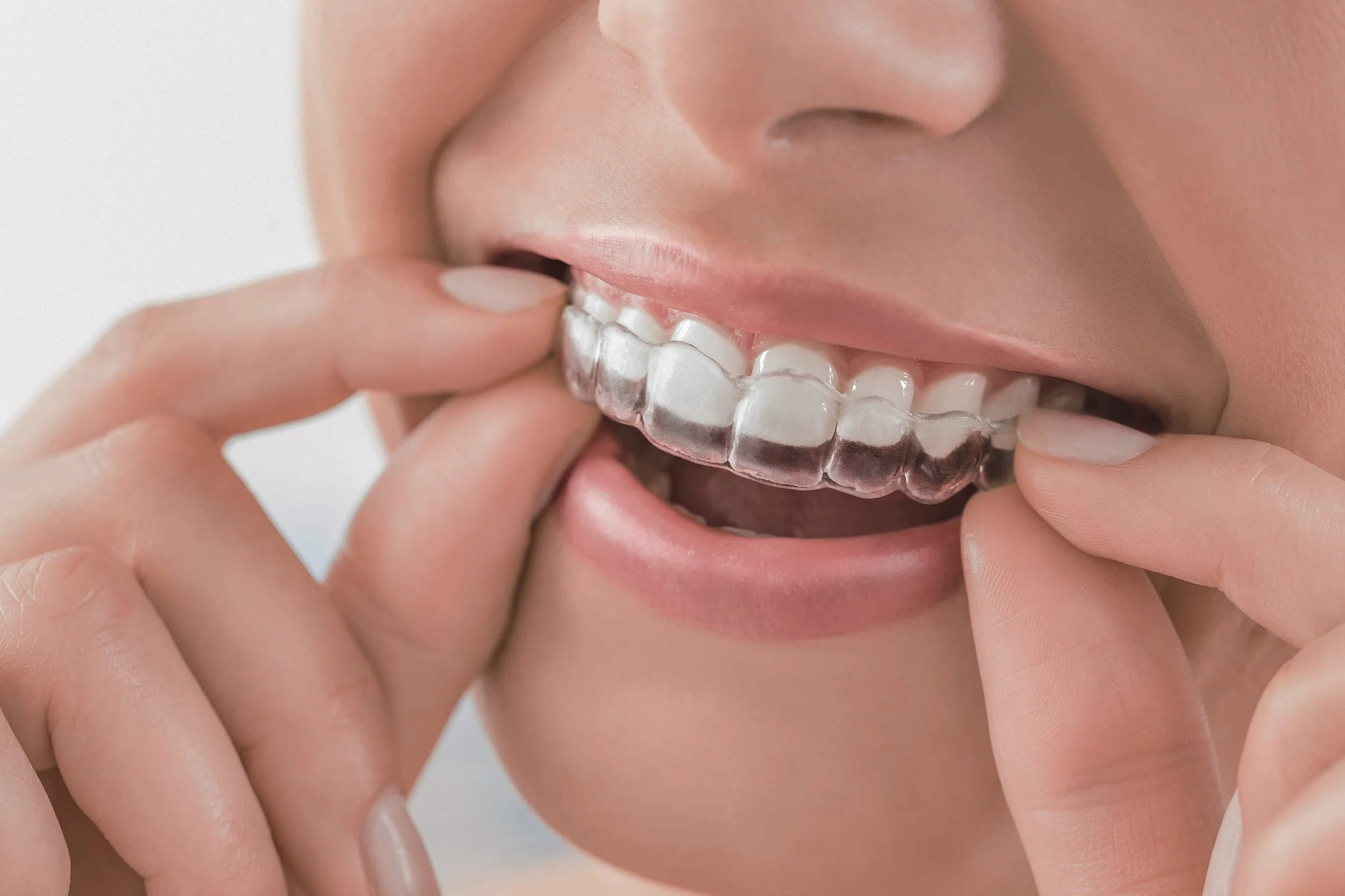 Invisible aligners treatment in Chennai