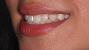 Benefits of invisible aligners Chennai