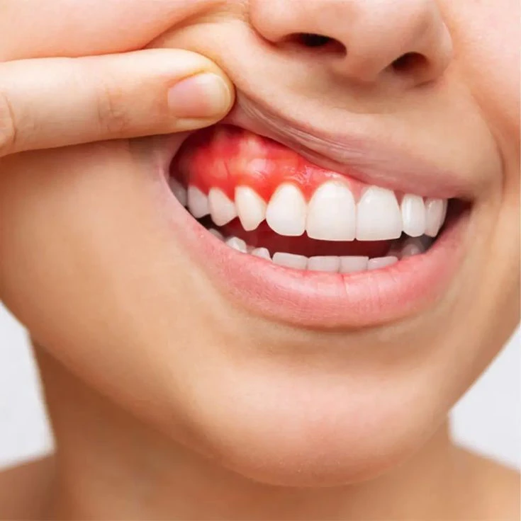 Gum treatment for periodontal care in Chennai