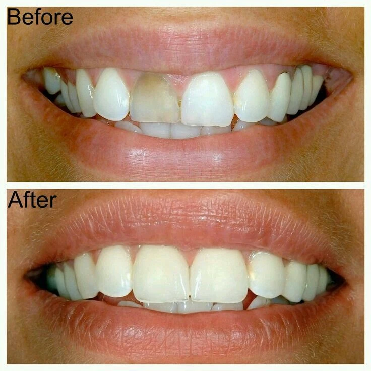 Benefits of gum treatment in Chennai
