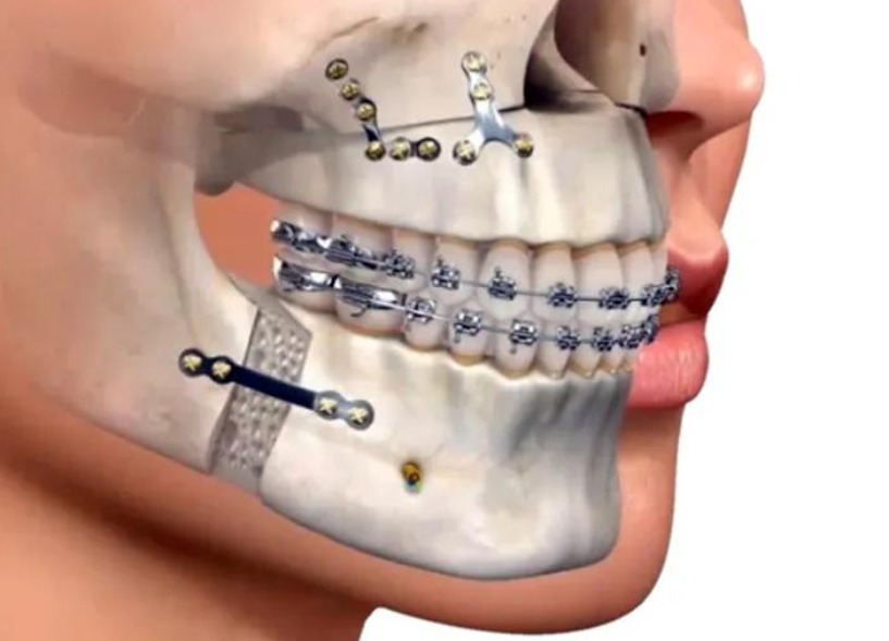 Dental implants treatment in Chennai