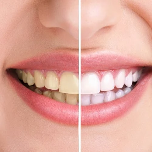 Teeth whitening treatment in Chennai