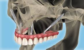 Zygoma implants treatment