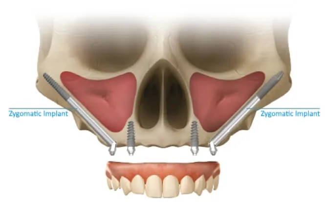 Zygoma implant procedure