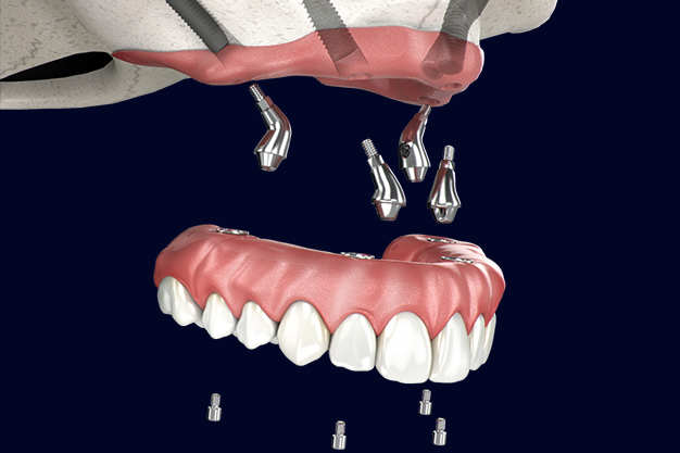 Benefits of zygoma implants