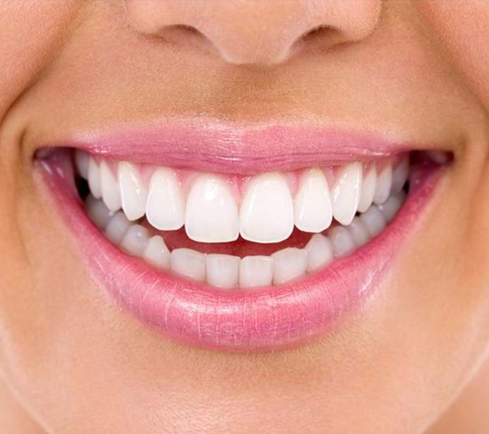 after whitening