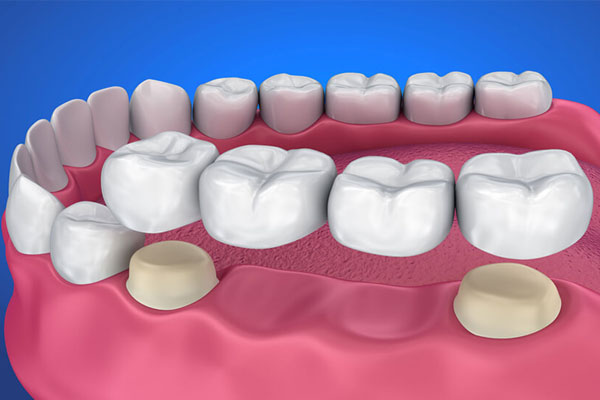 dental crowns treatment