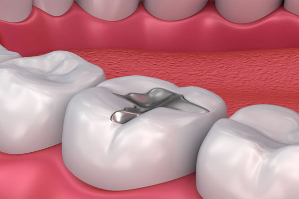 dental fillings treatment