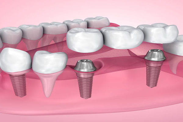 dental implants treatment